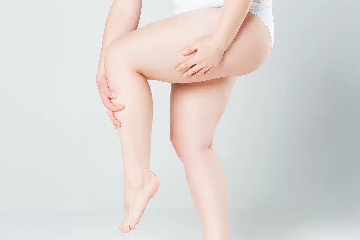Woman's leg with cellulite.